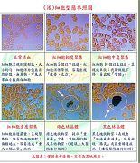 何謂:代謝症候群