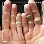 打球手上起了水泡怎麼辦?!